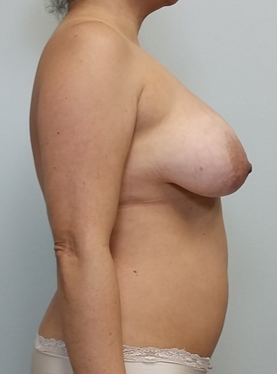 Breast Lift Case 10026 Before Photo Breast Lift