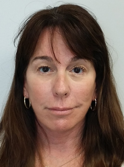 Facelift Case 10023 After Photo Facelift