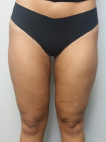 Liposuction