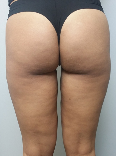 Liposuction