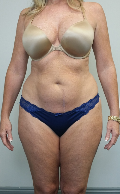 Liposuction Case 9946 Before Photo Liposuction