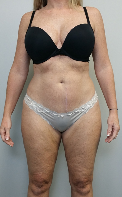 Liposuction Case 9946 After Photo Liposuction