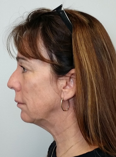 Neck Lift Case 9958 Before Photo Neck Lift