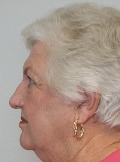 Rhinoplasty/Nose Reshaping Case 9964 After Photo Rhinoplasty/Nose Reshaping