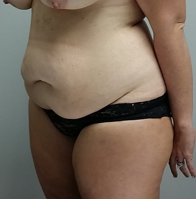 Tummy tuck (Abdominoplasty) Case 9966 Before Photo Tummy tuck (Abdominoplasty)