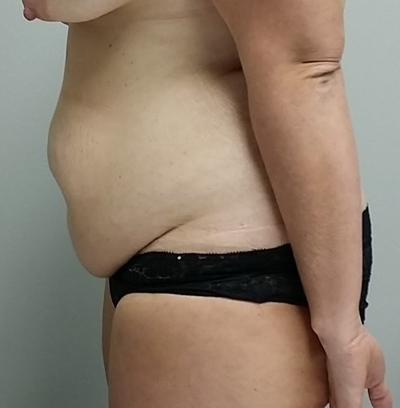Tummy tuck (Abdominoplasty) Case 9966 Before Photo Tummy tuck (Abdominoplasty)