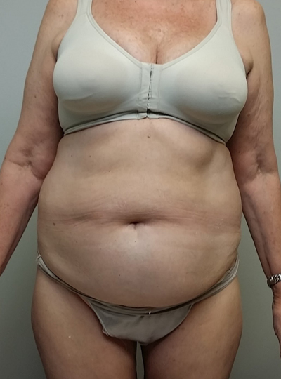 Tummy tuck (Abdominoplasty)