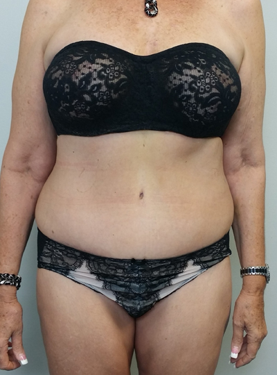 Tummy tuck (Abdominoplasty)