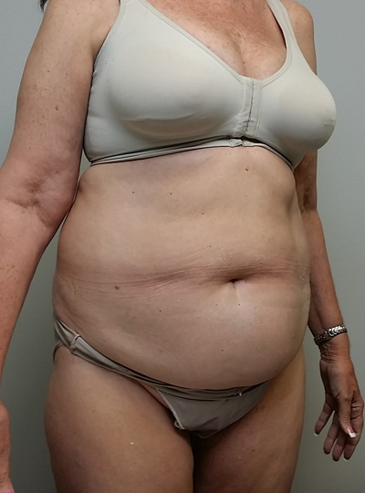 Tummy tuck (Abdominoplasty)