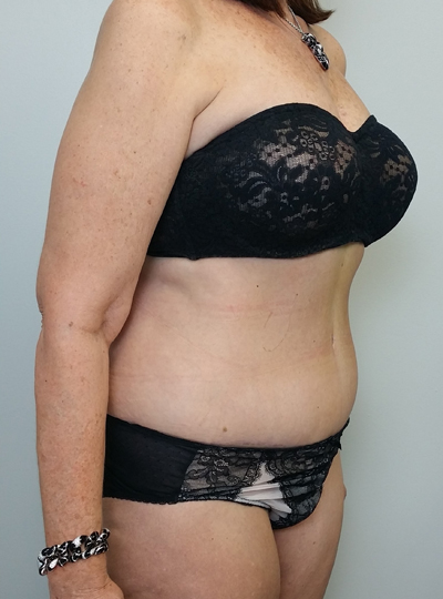 Tummy tuck (Abdominoplasty) Case 10012 After Photo Tummy tuck (Abdominoplasty)