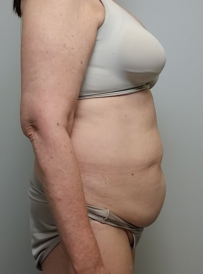 Tummy tuck (Abdominoplasty) Case 10012 Before Photo Tummy tuck (Abdominoplasty)