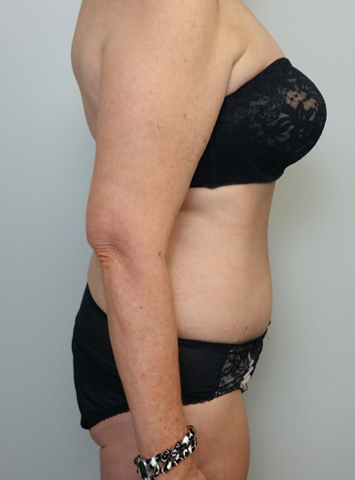 Tummy tuck (Abdominoplasty)