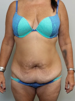 Tummy tuck (Abdominoplasty)