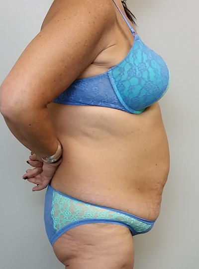Tummy tuck (Abdominoplasty) Case 10050 Before Photo Tummy tuck (Abdominoplasty)