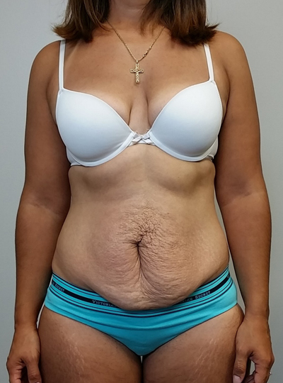 Tummy tuck (Abdominoplasty)