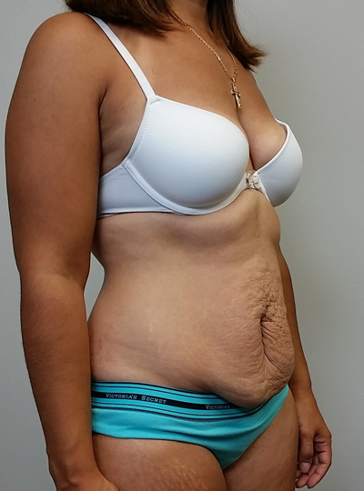 Tummy tuck (Abdominoplasty)