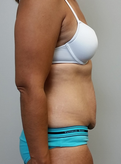 Tummy tuck (Abdominoplasty)