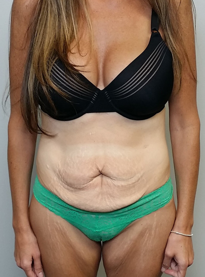 Tummy tuck (Abdominoplasty)