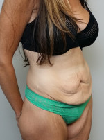 Tummy tuck (Abdominoplasty)