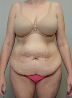 Tummy tuck (Abdominoplasty)
