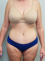 Tummy tuck (Abdominoplasty)