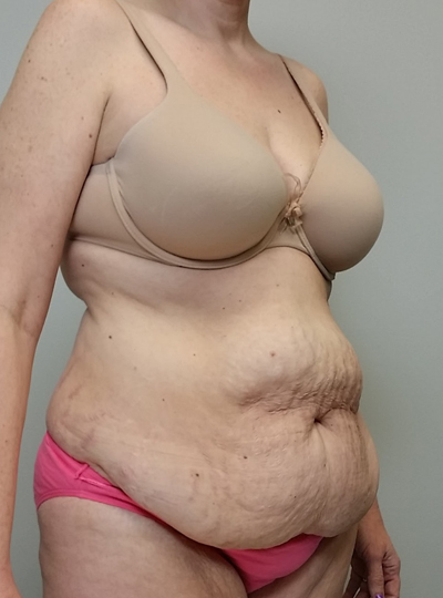 Tummy tuck (Abdominoplasty)