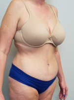 Tummy tuck (Abdominoplasty)
