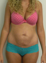 Tummy tuck (Abdominoplasty)