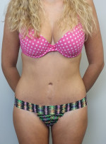 Tummy tuck (Abdominoplasty)