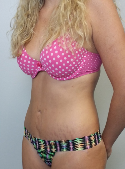 Tummy tuck (Abdominoplasty)