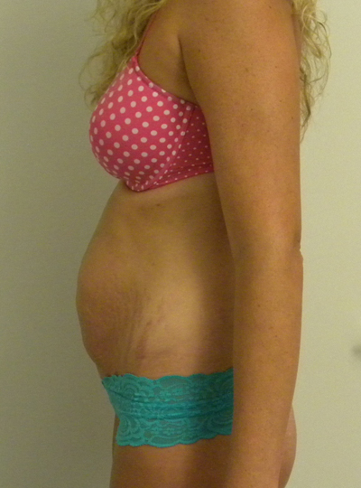 Tummy tuck (Abdominoplasty) Case 10088 Before Photo Tummy tuck (Abdominoplasty)