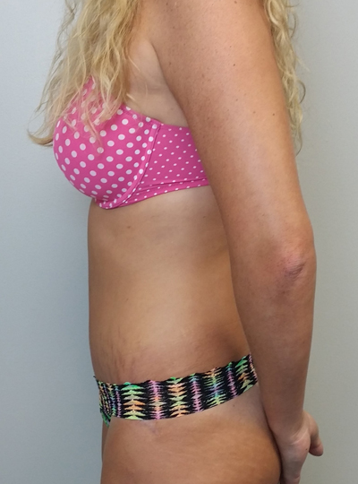 Tummy tuck (Abdominoplasty) Case 10088 After Photo Tummy tuck (Abdominoplasty)