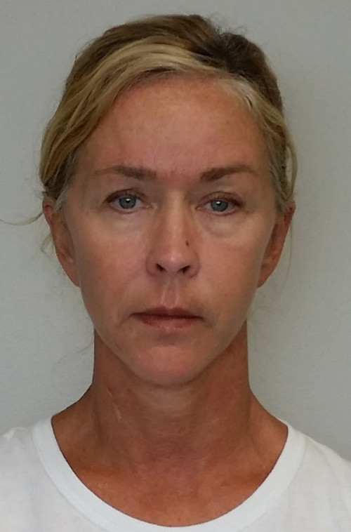 Facelift Case 10109 Before Photo Facelift