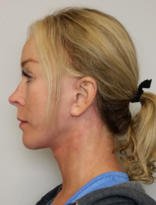 Facelift Case 10109 After Photo Facelift