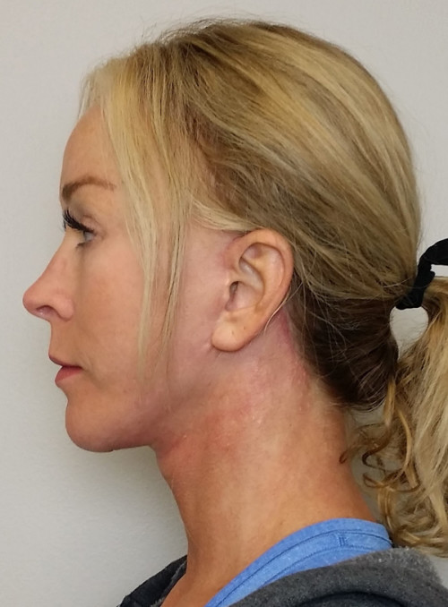 Neck Lift Case 10118 After Photo Neck Lift