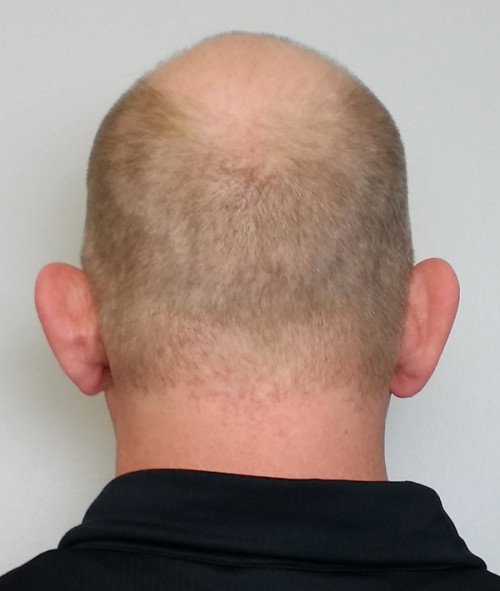 Otoplasty/Cosmetic Ear Surgery Case 10186 Before Photo Otoplasty/Cosmetic Ear Surgery