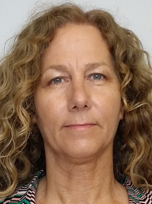 Rhinoplasty/Nose Reshaping Case 10192 After Photo Rhinoplasty/Nose Reshaping