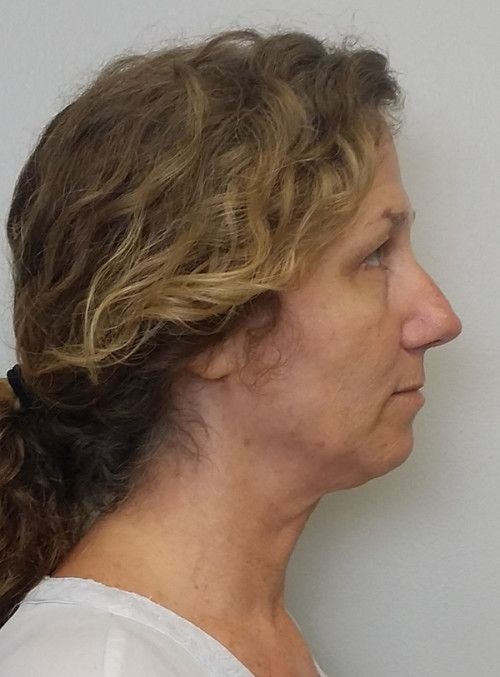 Rhinoplasty/Nose Reshaping Case 10192 Before Photo Rhinoplasty/Nose Reshaping