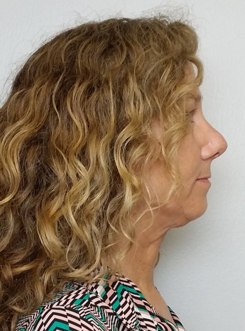 Rhinoplasty/Nose Reshaping Case 10192 After Photo Rhinoplasty/Nose Reshaping
