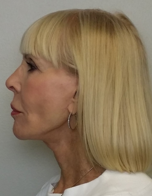 Neck Lift Case 10178 After Photo Neck Lift