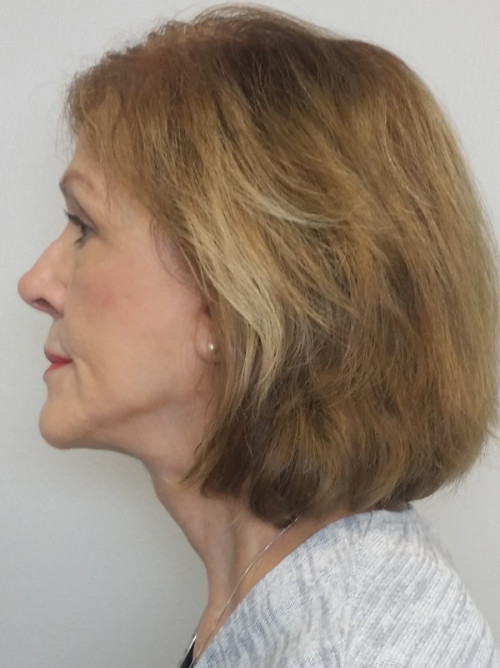 Neck Lift