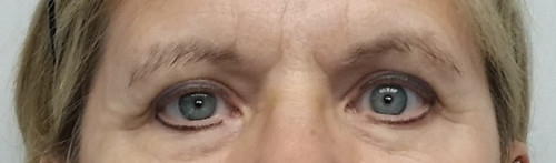 Eyelid Surgery Case 10162 Before Photo Eyelid Surgery