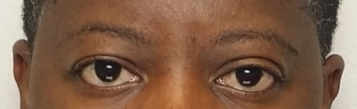 Eyelid Surgery Case 10170 Before Photo Eyelid Surgery
