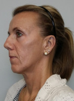 Facelift