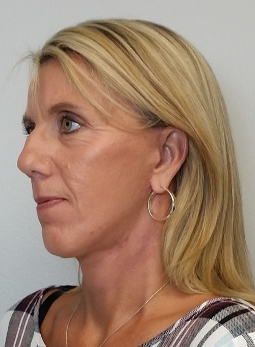 Facelift Case 10260 After Photo Facelift