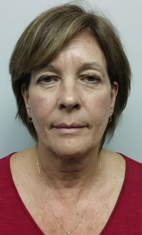 Facelift Case 10268 Before Photo Facelift