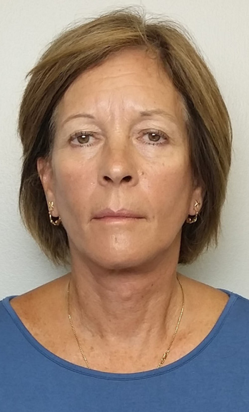 Facelift Case 10268 After Photo Facelift