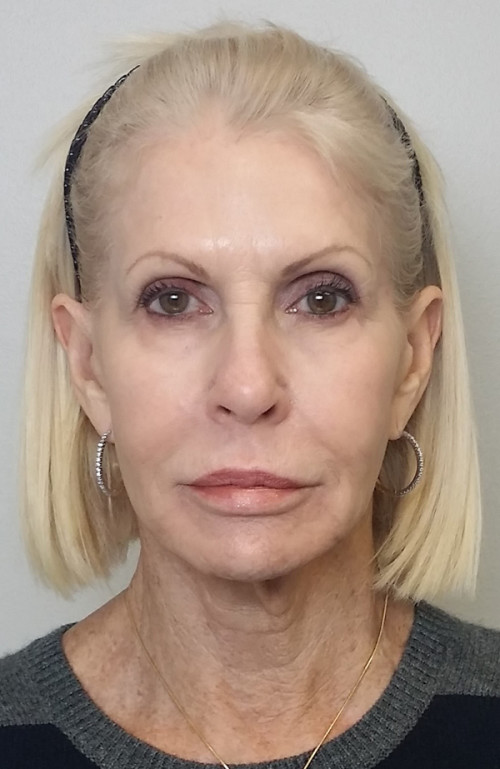Facelift Case 10272 Before Photo Facelift