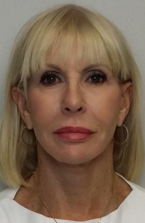 Facelift Case 10272 After Photo Facelift