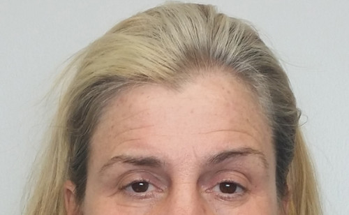 Brow Lift/Forehead Rejuvenation Case 10240 Before Photo Brow Lift/Forehead Rejuvenation